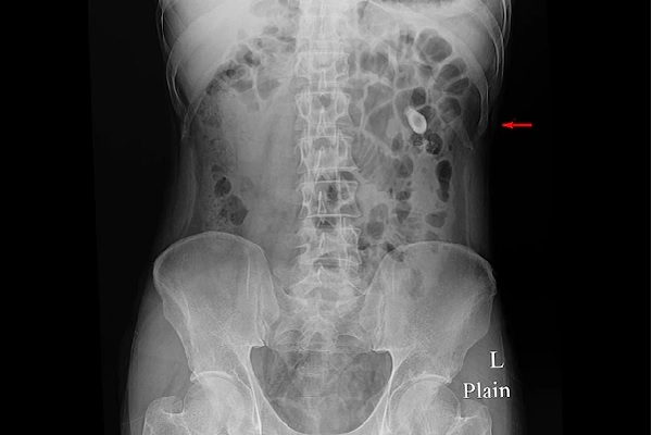 Kidney Stone X-Ray